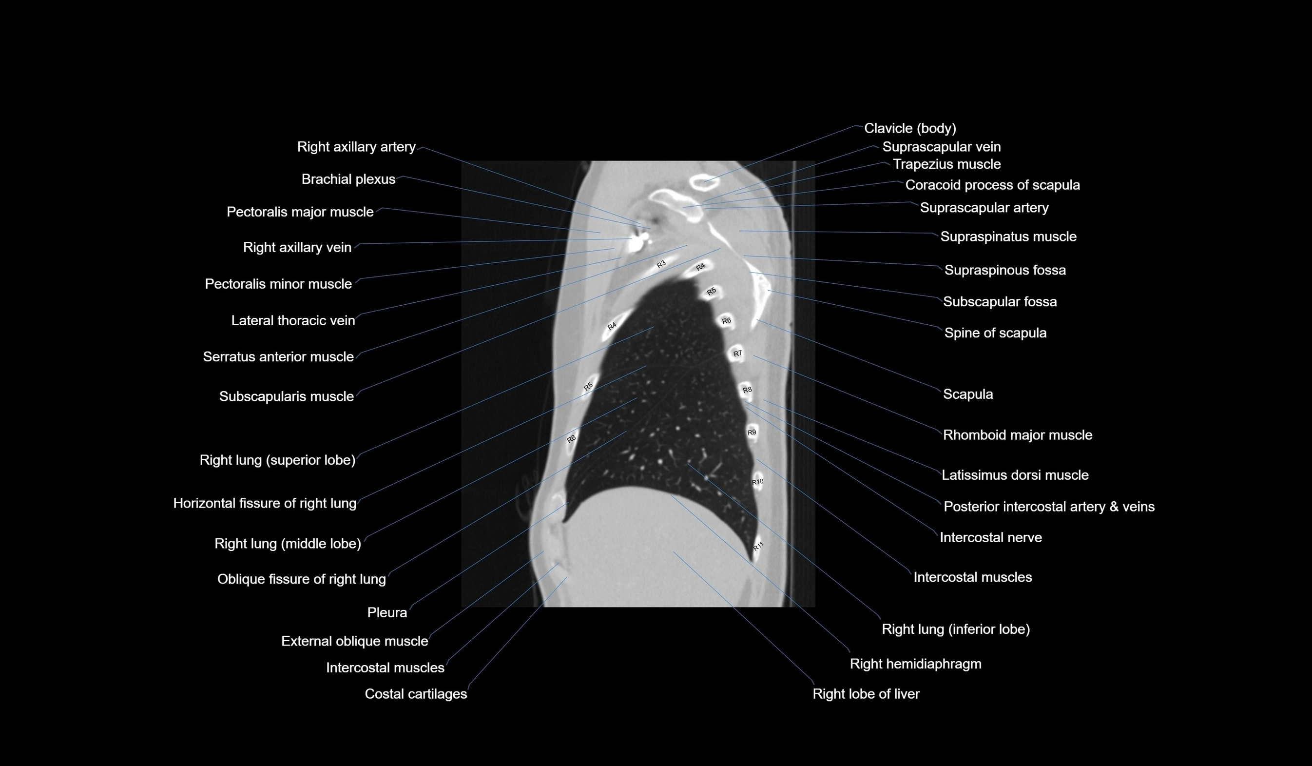 CT chest (thorax) lung window labelled sagittal cross sectional anatomy radiology image-00028.webp